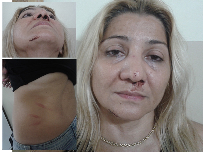 Maria de Fátima apresentava vários hematomas pelo corpo e rosto. Fotos tiradas no momento em que a vítima aguardava atendimento no IML